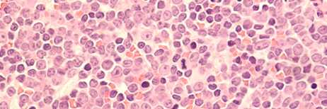 bone marrow biopsy shows replacement of normal elements by diffuse large B-cell Lymphoma, a type of
non-Hodgkin Lymphoma
