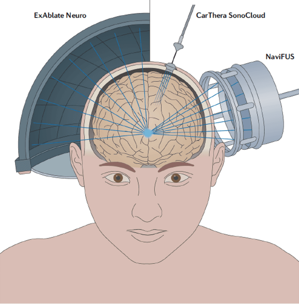 FUS is applied externally to the brain and directed at a target, in some cases without requiring an incision. A variety of FUS devices are currently available and in clinical trial.