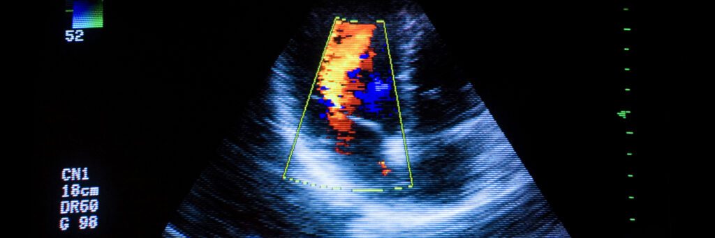 Heart ultrasound image on computer
screen