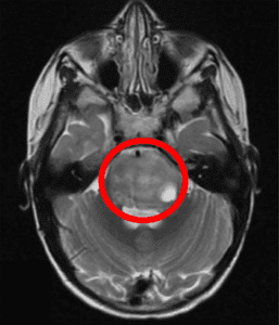 Magnetic Resonance Imaging (MRI) of a DIPG tumor, arising within the pons (red circle).