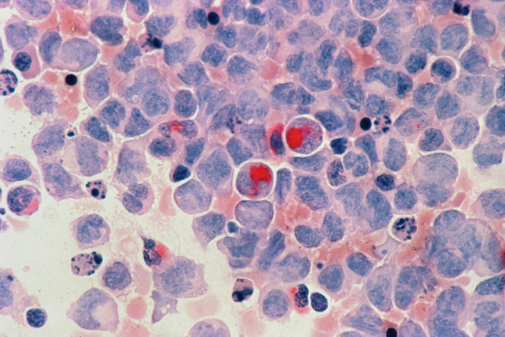 A microscopic view of adult AML cancer cells